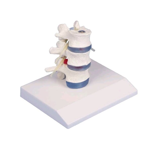 Erler Zimmer lumbar model with disc herniation, can be dismantled