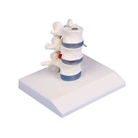Erler Zimmer lumbar model with disc herniation, can be...