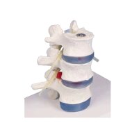Erler Zimmer lumbar model with disc herniation, can be...