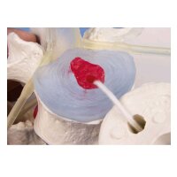 Erler Zimmer lumbar model with disc herniation, can be dismantled