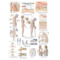 Erler Zimmer anatomical chart "osteoporosis",...