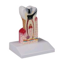 Dental caries model Erler Zimmer, lower molar, 10 times...