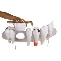 Dental model by Erler Zimmer, lower jaw with teeth 3 -7,...