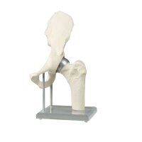 Erler Zimmer Hip Joint with Resurfacing Implant -...