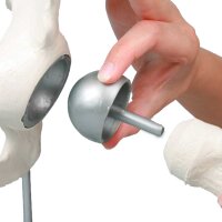 Erler Zimmer Hip Joint with Resurfacing Implant -...