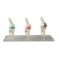 Erler Zimmer Knee Implant Model, 3 pcs, Healthy,...