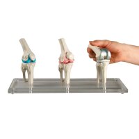 Erler Zimmer Knee Implant Model, 3 pcs, Healthy,...