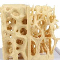 Erler Zimmer Comparision Model - Healthy/Osteoporotic...