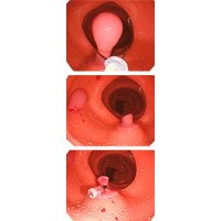 Erler Zimmer Simulated Polyps - Upgrade for Training...